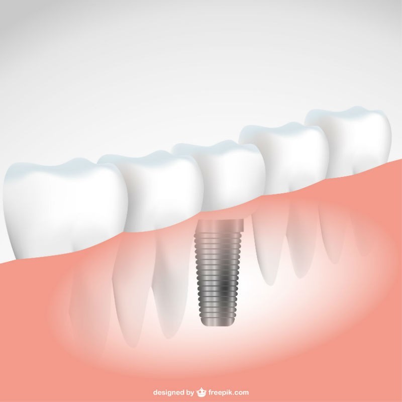 , Dentalni implantati &#8211; Moderan način dentalne protetike