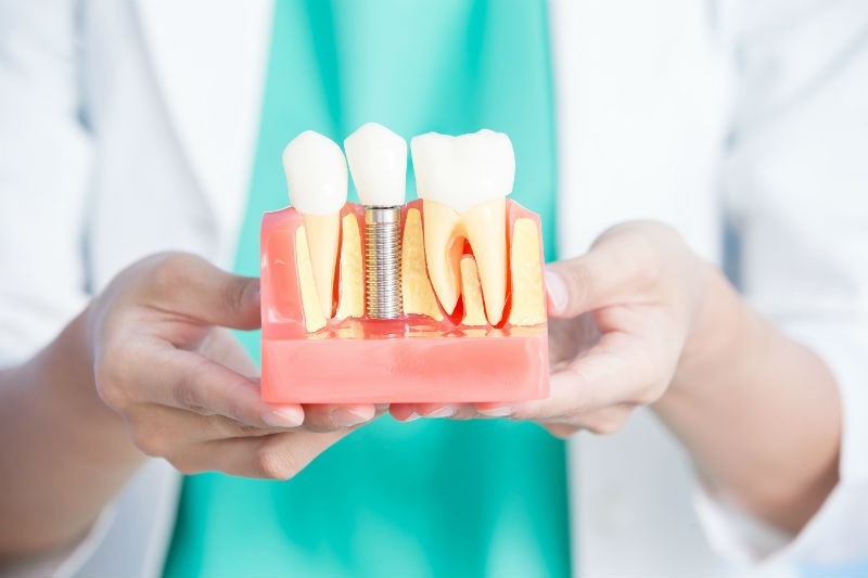 , Šta sve treba da znate pre ugradnje zubnih implantata?
