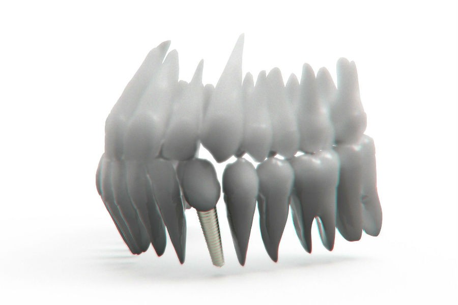 , Zubni implanti &#8211; od ideje do (naučne) revolucije