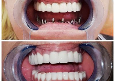 , Zubni implanti – iskustva pacijenata