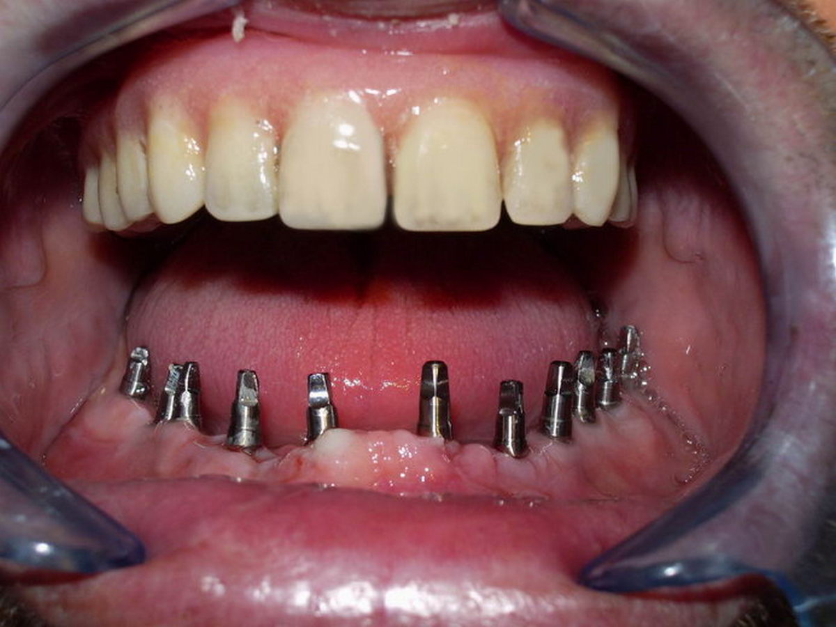 , Bazalni zubni implanti