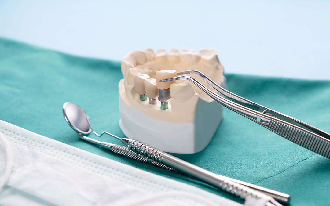 , Implantološke indikacije za ekstrakcije zuba