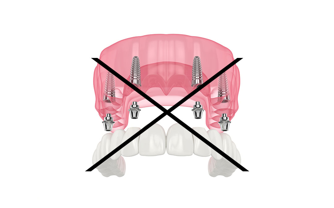, Zašto zubni implanti ALL-ON-4 nisu najbolje rešenje